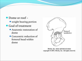 Dome or roof –
weight bearing portion
Goal of treatment
Anatomic restoration of
dome
Concentric reduction of
femoral head within
dome
 
