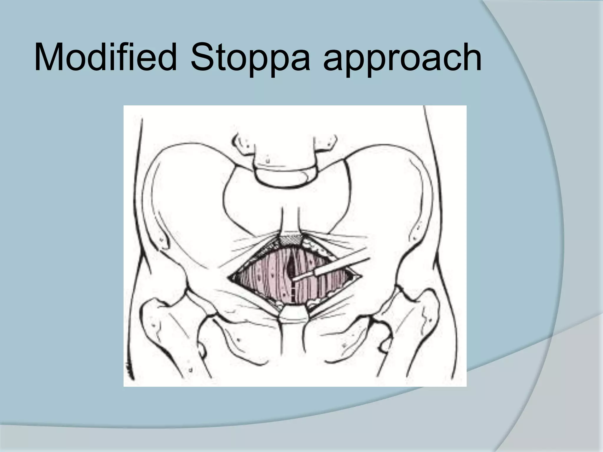 Acetabulum fractures | PPTX