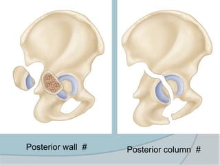 Posterior wall # Posterior column #
 