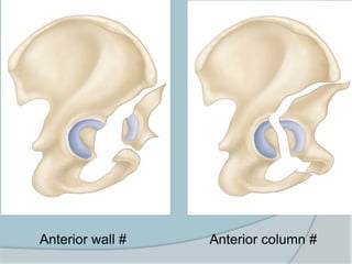 Anterior wall # Anterior column #
 
