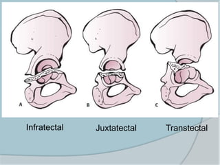 Infratectal Juxtatectal Transtectal
 