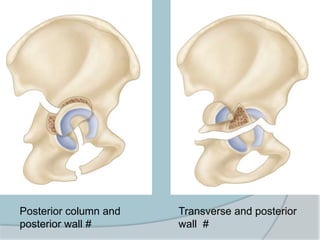 Posterior column and
posterior wall #
Transverse and posterior
wall #
 