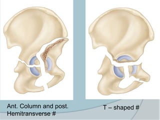 T – shaped #Ant. Column and post.
Hemitransverse #
 