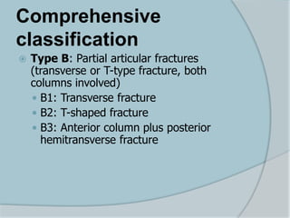 Comprehensive
classification
 Type B: Partial articular fractures
(transverse or T-type fracture, both
columns involved)
 B1: Transverse fracture
 B2: T-shaped fracture
 B3: Anterior column plus posterior
hemitransverse fracture
 