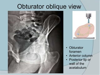 Obturator oblique view
• Obturator
foramen
• Anterior column
• Posterior lip or
wall of the
acetabulum
 