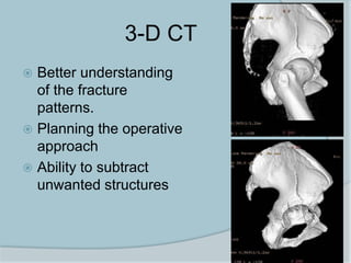 3-D CT
 Better understanding
of the fracture
patterns.
 Planning the operative
approach
 Ability to subtract
unwanted structures
 