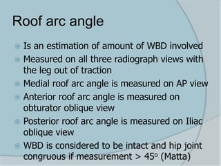 Roof arc angle
 Is an estimation of amount of WBD involved
 Measured on all three radiograph views with
the leg out of traction
 Medial roof arc angle is measured on AP view
 Anterior roof arc angle is measured on
obturator oblique view
 Posterior roof arc angle is measured on Iliac
oblique view
 WBD is considered to be intact and hip joint
congruous if measurement > 45o (Matta)
 
