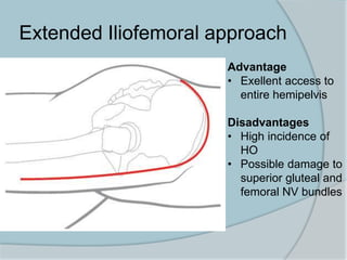 Extended Iliofemoral approach
Advantage
• Exellent access to
entire hemipelvis
Disadvantages
• High incidence of
HO
• Possible damage to
superior gluteal and
femoral NV bundles
 