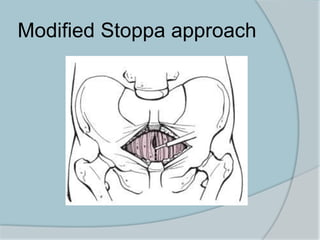 Modified Stoppa approach
 