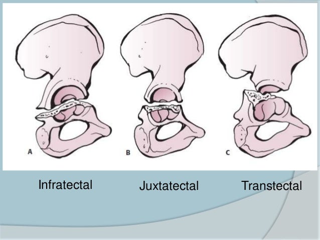 transverse acetabular fracture transverse acetabular fracture