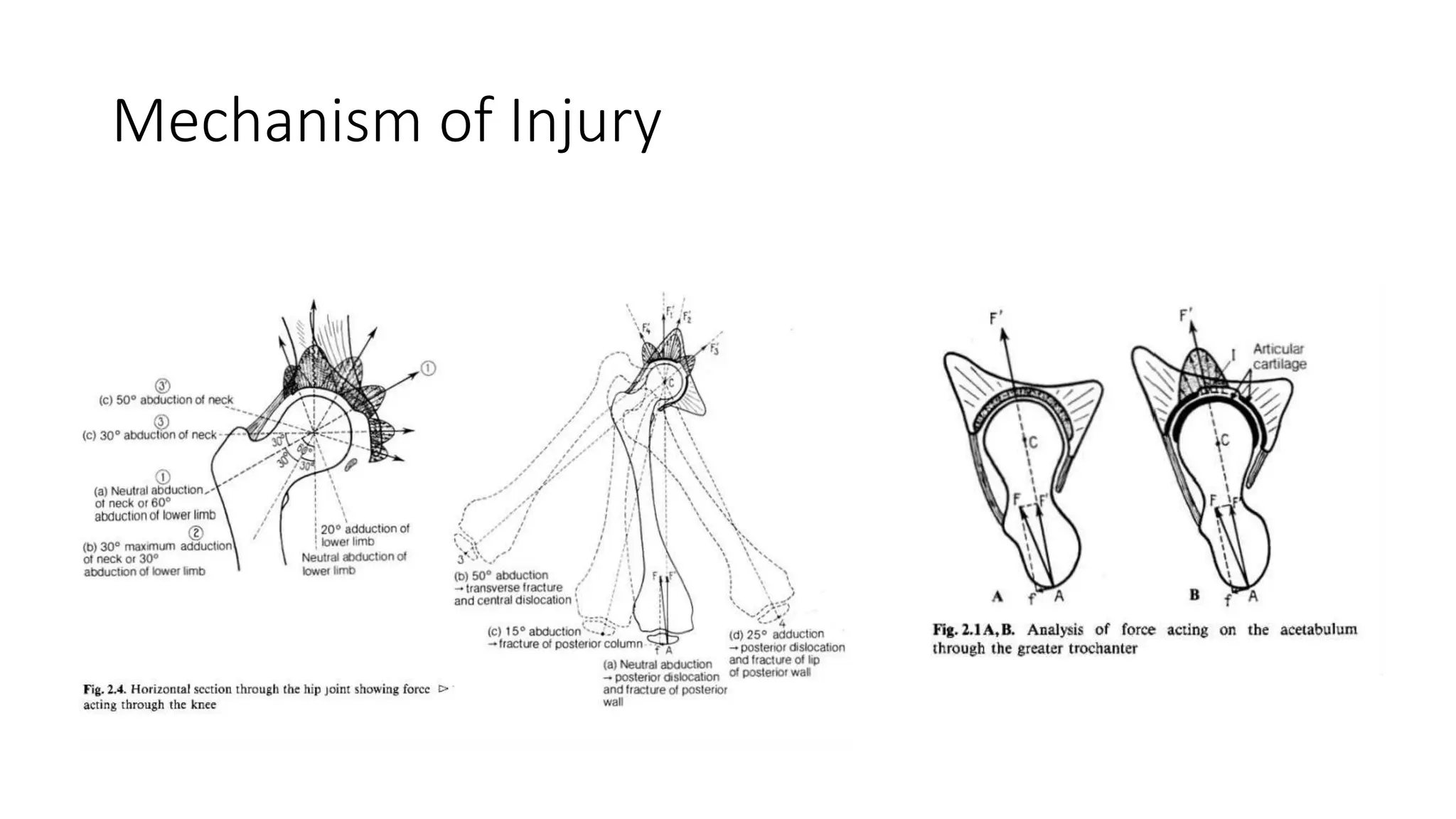 Acetabulum Fractures - Anatomy, Radiological Evaluation, Classification ...