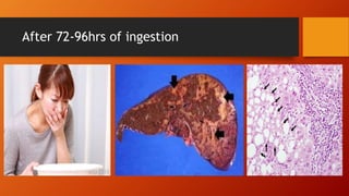 Acetaminophen overdose | PPTX