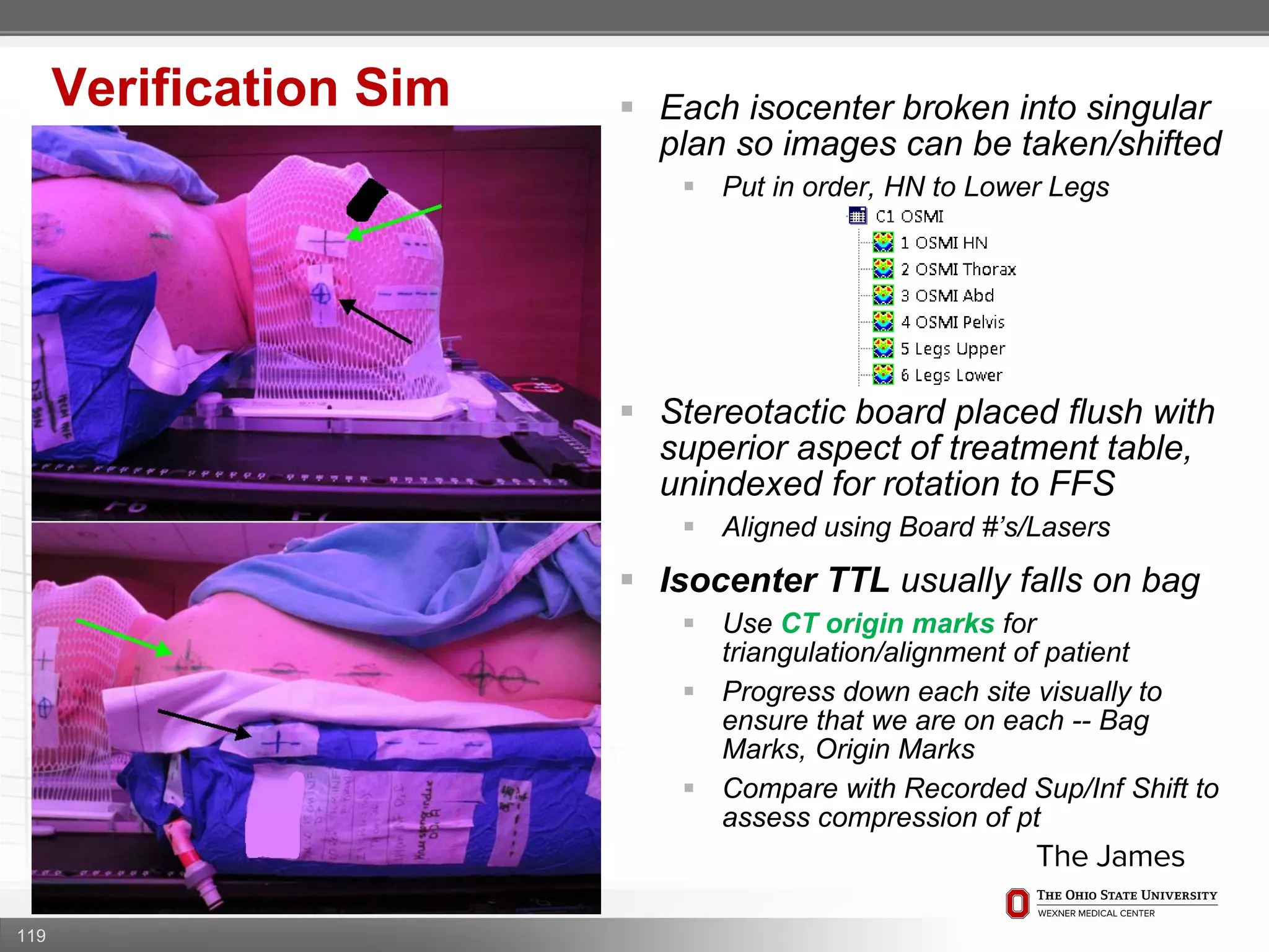 119
Verification Sim  Each isocenter broken into singular
plan so images can be taken/shifted
 Put in order, HN to Lower Legs
 Stereotactic board placed flush with
superior aspect of treatment table,
unindexed for rotation to FFS
 Aligned using Board #’s/Lasers
 Isocenter TTL usually falls on bag
 Use CT origin marks for
triangulation/alignment of patient
 Progress down each site visually to
ensure that we are on each -- Bag
Marks, Origin Marks
 Compare with Recorded Sup/Inf Shift to
assess compression of pt
 