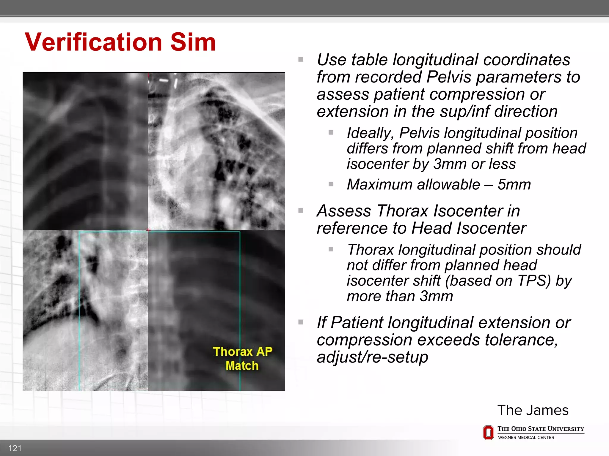 121
Verification Sim
 Use table longitudinal coordinates
from recorded Pelvis parameters to
assess patient compression or
extension in the sup/inf direction
 Ideally, Pelvis longitudinal position
differs from planned shift from head
isocenter by 3mm or less
 Maximum allowable – 5mm
 Assess Thorax Isocenter in
reference to Head Isocenter
 Thorax longitudinal position should
not differ from planned head
isocenter shift (based on TPS) by
more than 3mm
 If Patient longitudinal extension or
compression exceeds tolerance,
adjust/re-setup
 