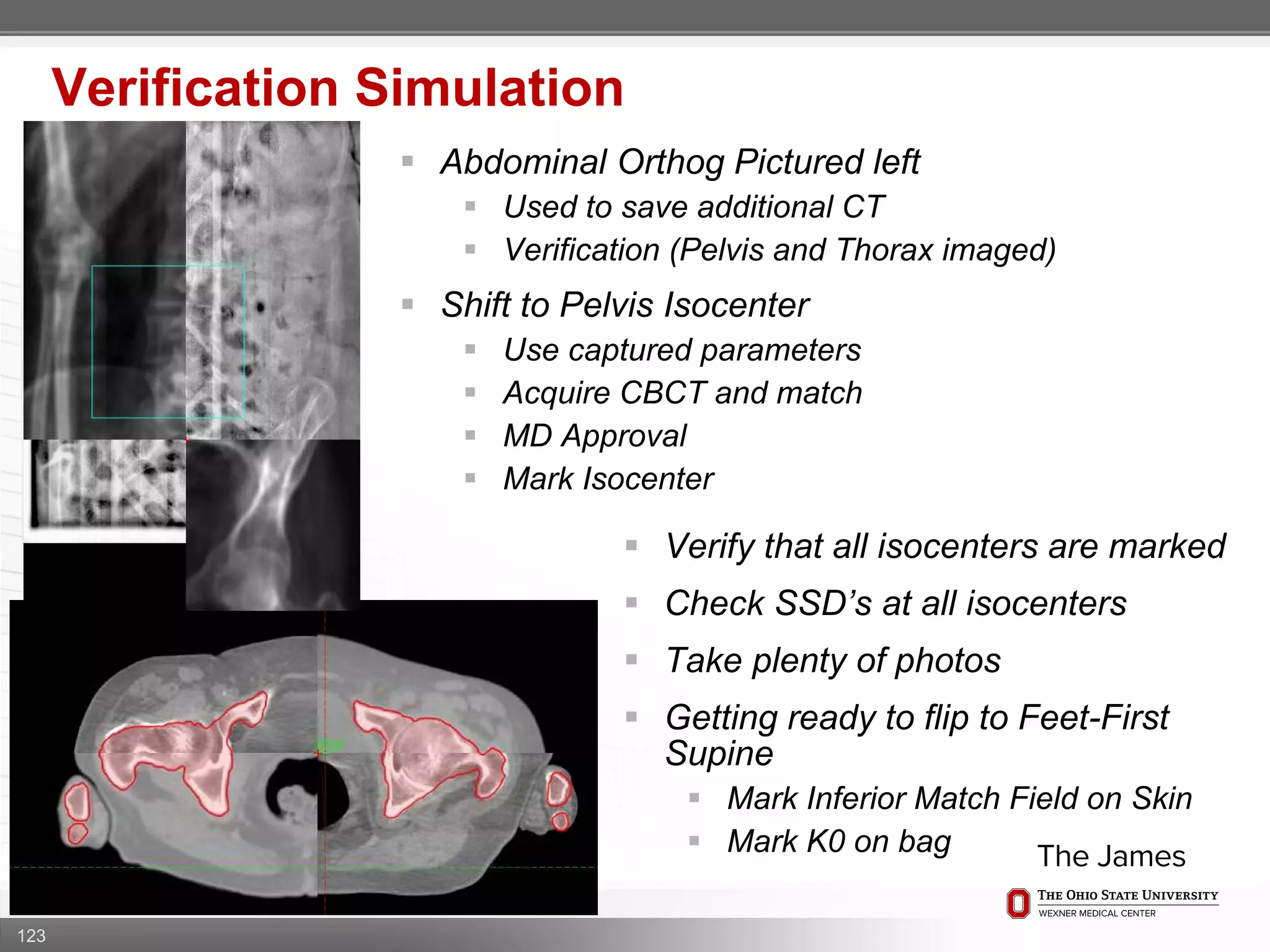 123
Verification Simulation
 Abdominal Orthog Pictured left
 Used to save additional CT
 Verification (Pelvis and Thorax imaged)
 Shift to Pelvis Isocenter
 Use captured parameters
 Acquire CBCT and match
 MD Approval
 Mark Isocenter
 Verify that all isocenters are marked
 Check SSD’s at all isocenters
 Take plenty of photos
 Getting ready to flip to Feet-First
Supine
 Mark Inferior Match Field on Skin
 Mark K0 on bag
 