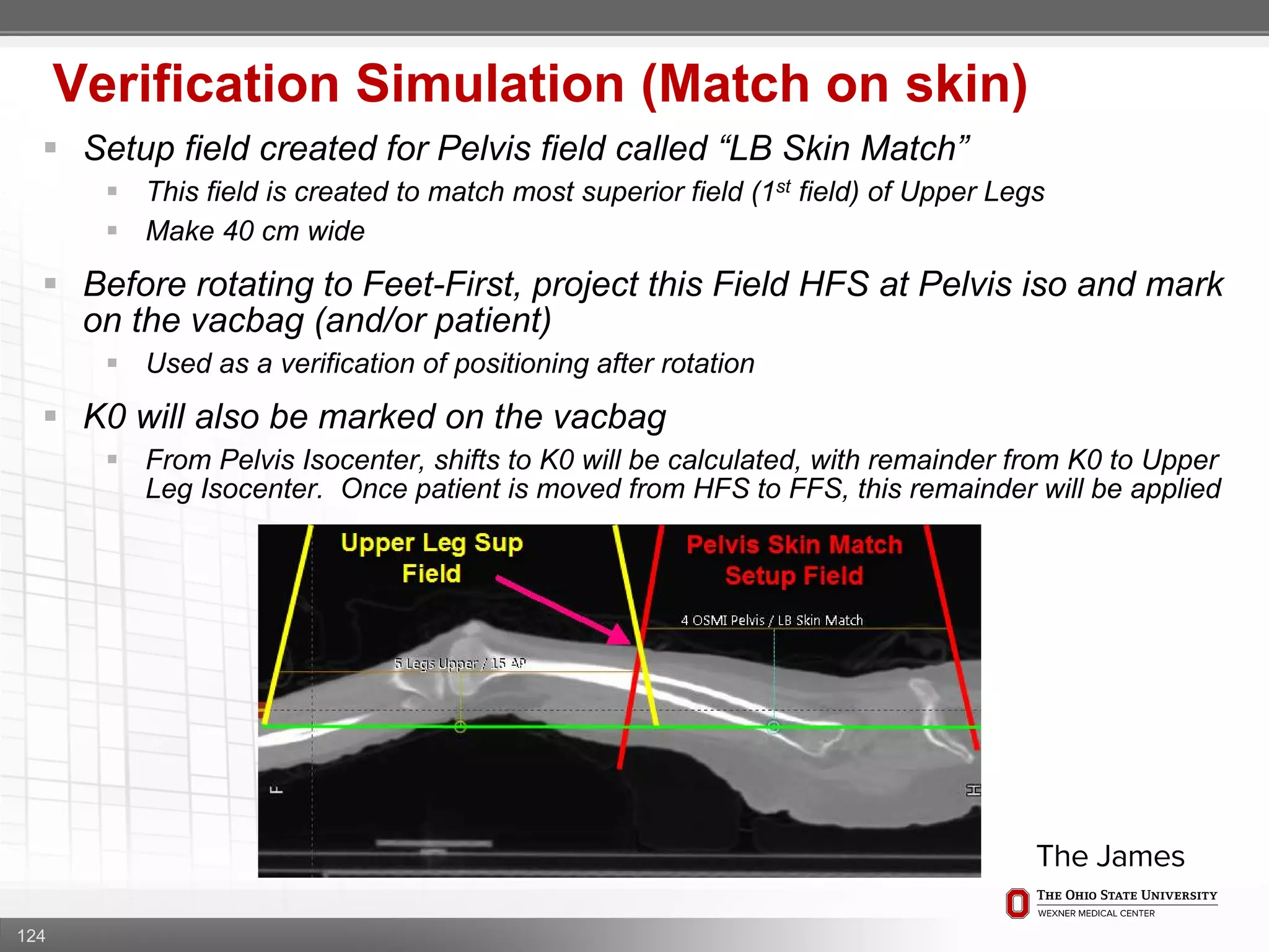 124
Verification Simulation (Match on skin)
 Setup field created for Pelvis field called “LB Skin Match”
 This field is created to match most superior field (1st field) of Upper Legs
 Make 40 cm wide
 Before rotating to Feet-First, project this Field HFS at Pelvis iso and mark
on the vacbag (and/or patient)
 Used as a verification of positioning after rotation
 K0 will also be marked on the vacbag
 From Pelvis Isocenter, shifts to K0 will be calculated, with remainder from K0 to Upper
Leg Isocenter. Once patient is moved from HFS to FFS, this remainder will be applied
 