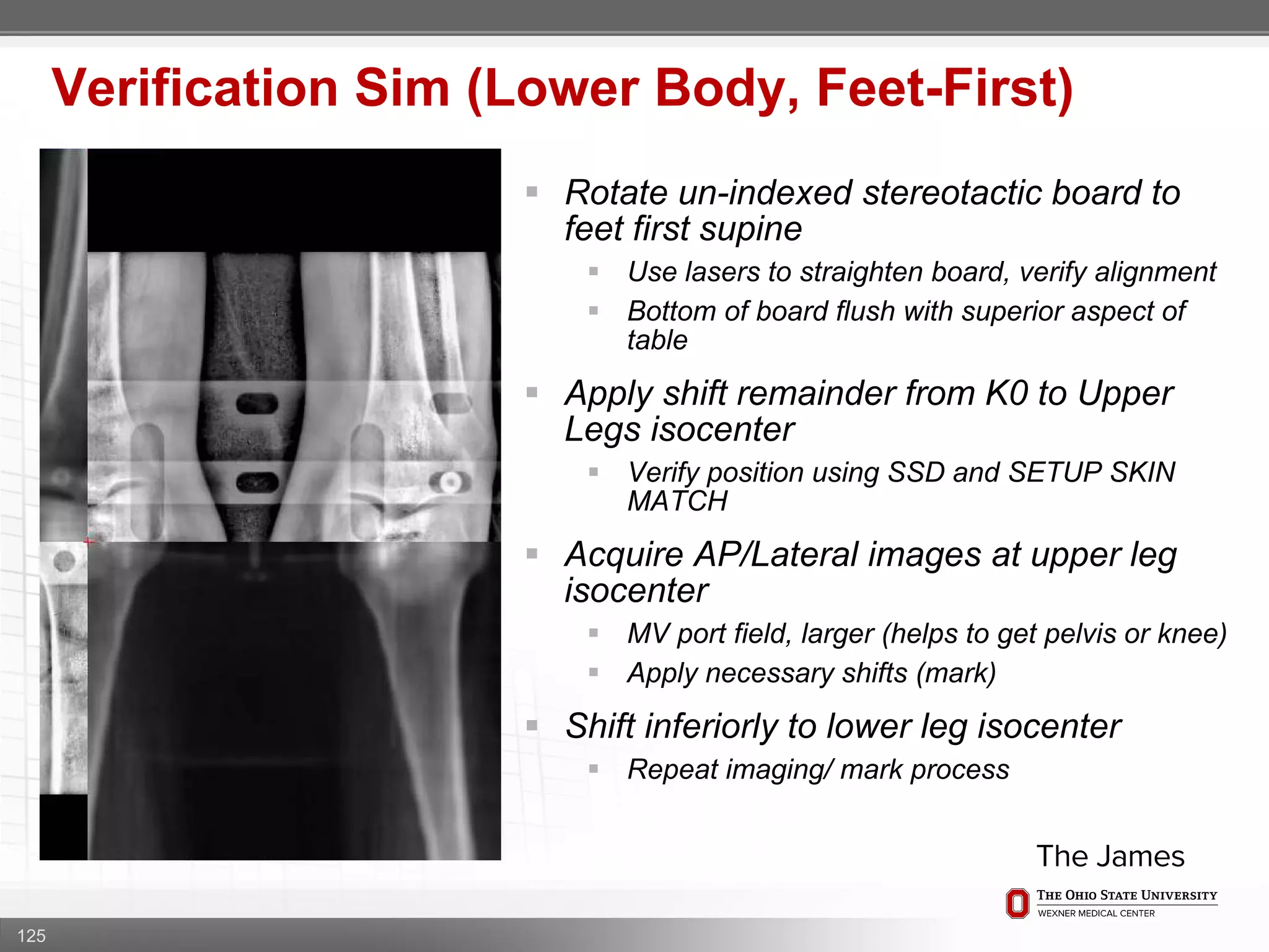 125
Verification Sim (Lower Body, Feet-First)
 Rotate un-indexed stereotactic board to
feet first supine
 Use lasers to straighten board, verify alignment
 Bottom of board flush with superior aspect of
table
 Apply shift remainder from K0 to Upper
Legs isocenter
 Verify position using SSD and SETUP SKIN
MATCH
 Acquire AP/Lateral images at upper leg
isocenter
 MV port field, larger (helps to get pelvis or knee)
 Apply necessary shifts (mark)
 Shift inferiorly to lower leg isocenter
 Repeat imaging/ mark process
 