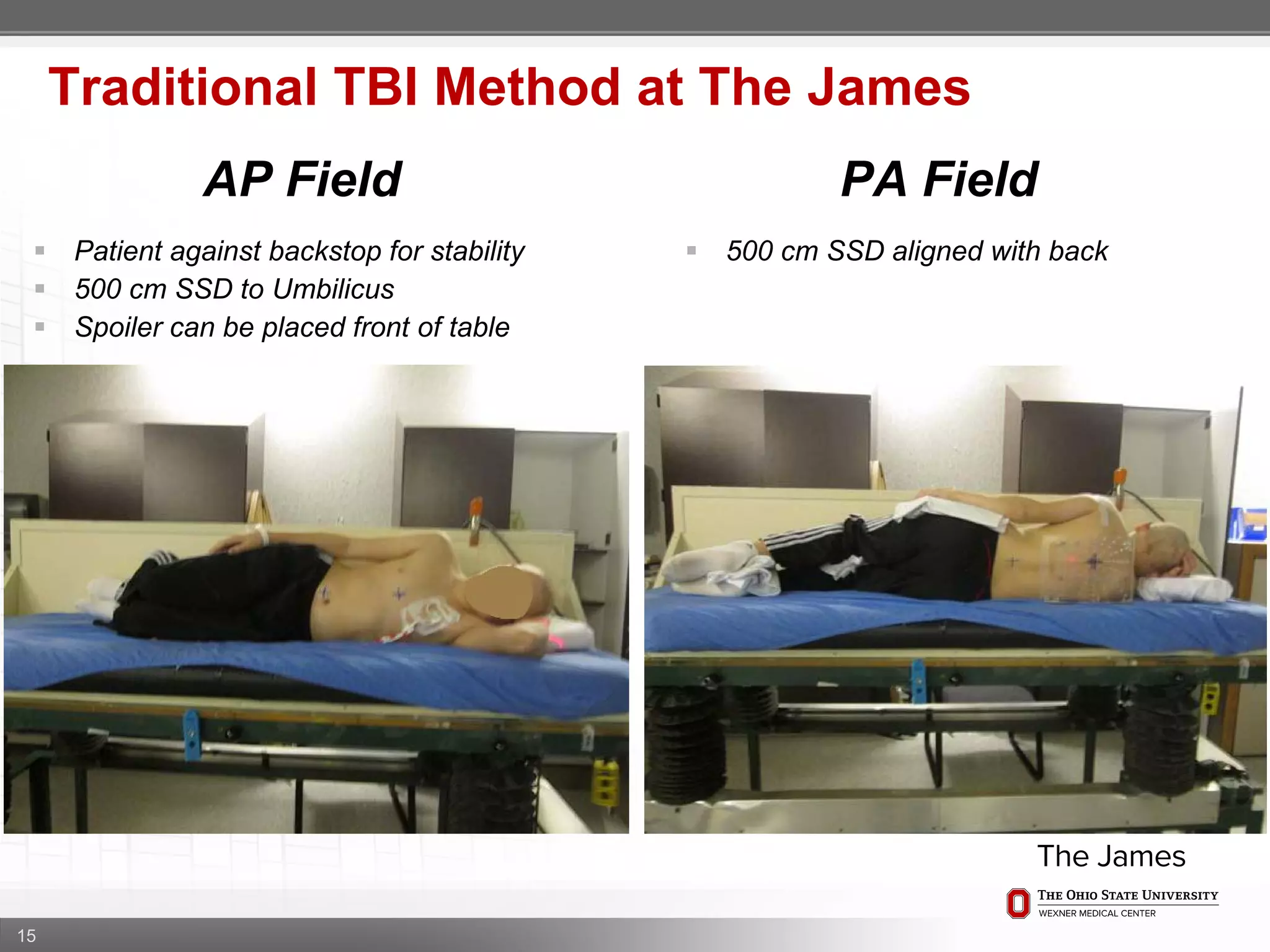 15
Traditional TBI Method at The James
AP Field PA Field
 Patient against backstop for stability
 500 cm SSD to Umbilicus
 Spoiler can be placed front of table
 500 cm SSD aligned with back
 