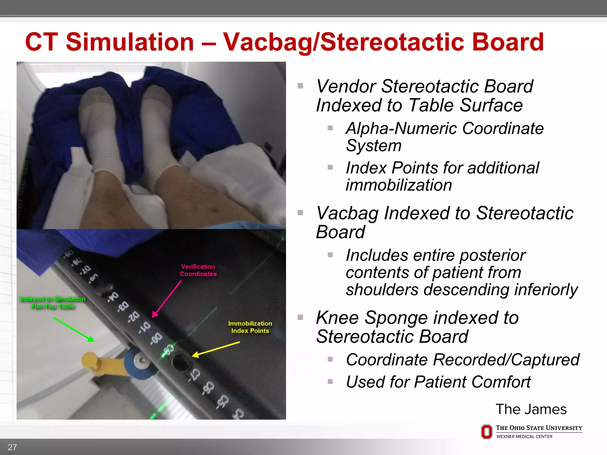 27
CT Simulation – Vacbag/Stereotactic Board
 Vendor Stereotactic Board
Indexed to Table Surface
 Alpha-Numeric Coordinate
System
 Index Points for additional
immobilization
 Vacbag Indexed to Stereotactic
Board
 Includes entire posterior
contents of patient from
shoulders descending inferiorly
 Knee Sponge indexed to
Stereotactic Board
 Coordinate Recorded/Captured
 Used for Patient Comfort
 