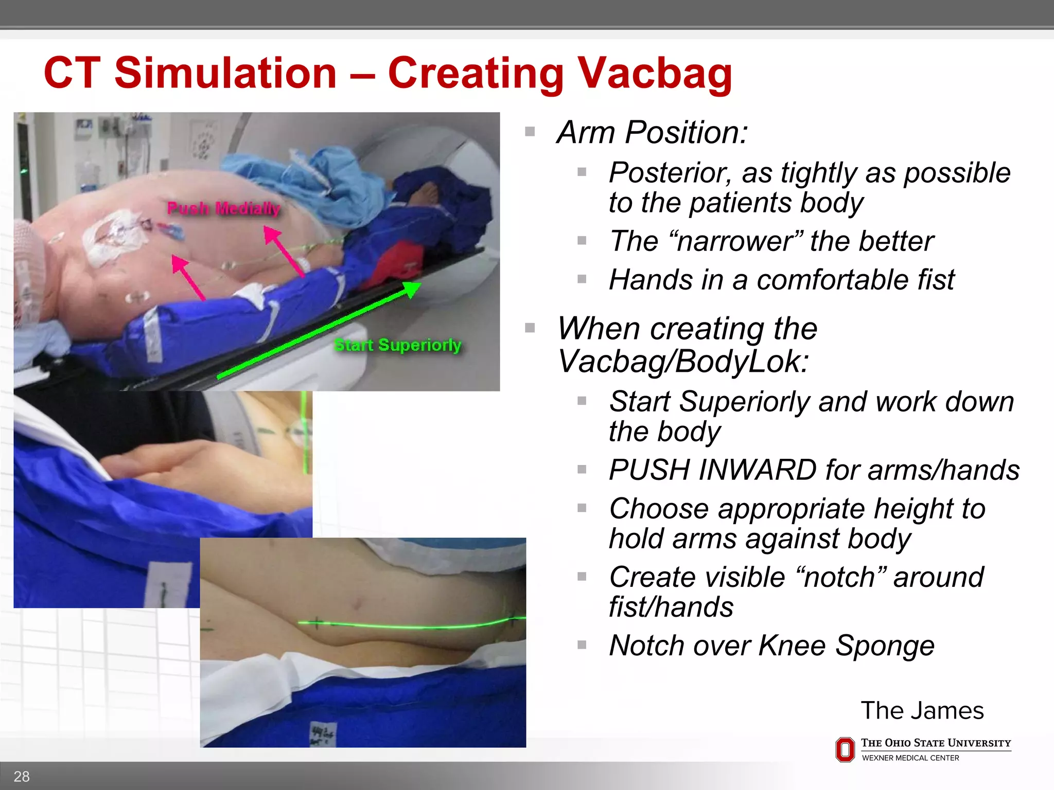 28
CT Simulation – Creating Vacbag
 Arm Position:
 Posterior, as tightly as possible
to the patients body
 The “narrower” the better
 Hands in a comfortable fist
 When creating the
Vacbag/BodyLok:
 Start Superiorly and work down
the body
 PUSH INWARD for arms/hands
 Choose appropriate height to
hold arms against body
 Create visible “notch” around
fist/hands
 Notch over Knee Sponge
 