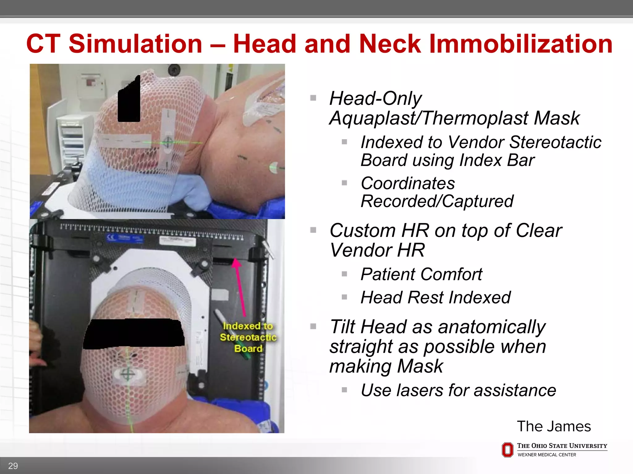 29
CT Simulation – Head and Neck Immobilization
 Head-Only
Aquaplast/Thermoplast Mask
 Indexed to Vendor Stereotactic
Board using Index Bar
 Coordinates
Recorded/Captured
 Custom HR on top of Clear
Vendor HR
 Patient Comfort
 Head Rest Indexed
 Tilt Head as anatomically
straight as possible when
making Mask
 Use lasers for assistance
 