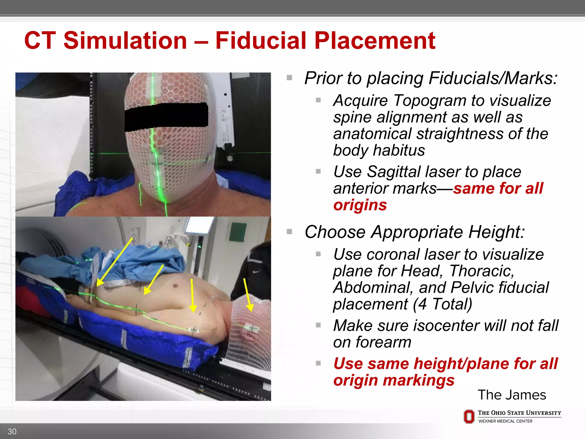 30
CT Simulation – Fiducial Placement
 Prior to placing Fiducials/Marks:
 Acquire Topogram to visualize
spine alignment as well as
anatomical straightness of the
body habitus
 Use Sagittal laser to place
anterior marks—same for all
origins
 Choose Appropriate Height:
 Use coronal laser to visualize
plane for Head, Thoracic,
Abdominal, and Pelvic fiducial
placement (4 Total)
 Make sure isocenter will not fall
on forearm
 Use same height/plane for all
origin markings
 