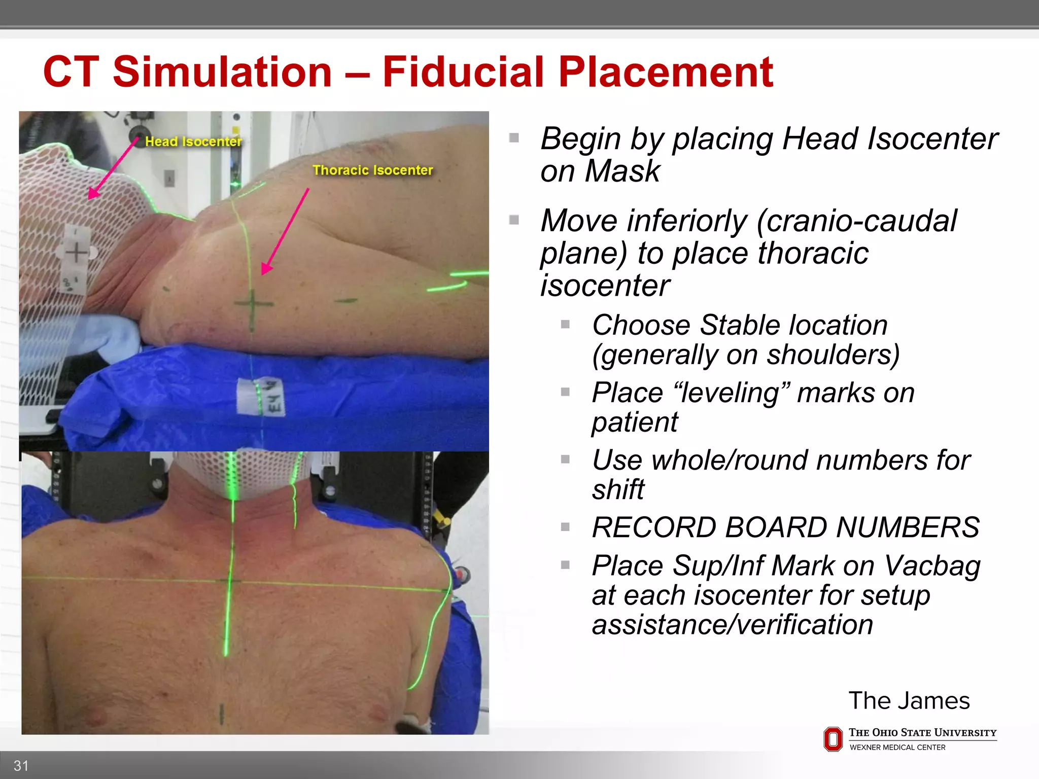 31
CT Simulation – Fiducial Placement
 Begin by placing Head Isocenter
on Mask
 Move inferiorly (cranio-caudal
plane) to place thoracic
isocenter
 Choose Stable location
(generally on shoulders)
 Place “leveling” marks on
patient
 Use whole/round numbers for
shift
 RECORD BOARD NUMBERS
 Place Sup/Inf Mark on Vacbag
at each isocenter for setup
assistance/verification
 