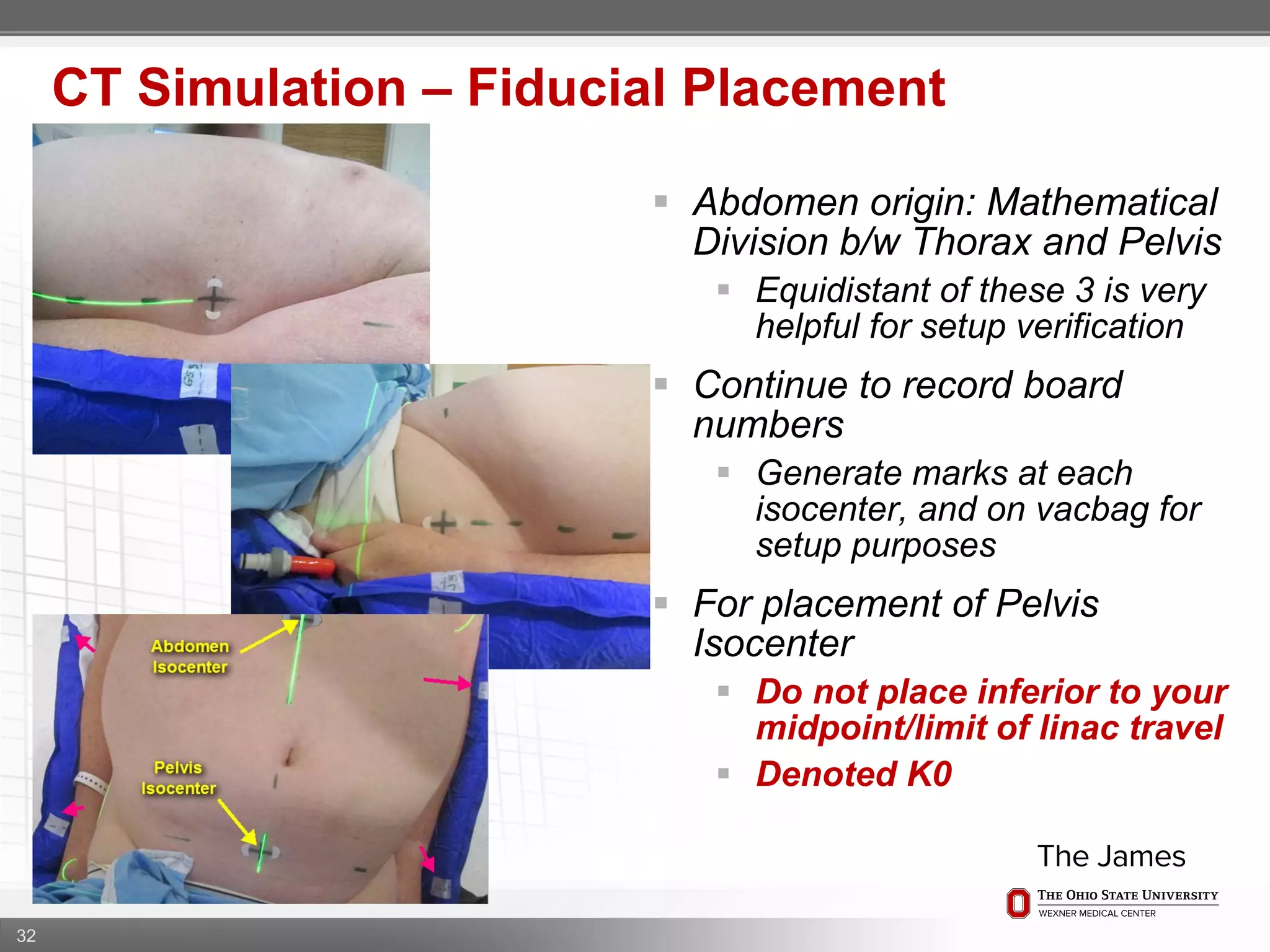 32
CT Simulation – Fiducial Placement
 Abdomen origin: Mathematical
Division b/w Thorax and Pelvis
 Equidistant of these 3 is very
helpful for setup verification
 Continue to record board
numbers
 Generate marks at each
isocenter, and on vacbag for
setup purposes
 For placement of Pelvis
Isocenter
 Do not place inferior to your
midpoint/limit of linac travel
 Denoted K0
 