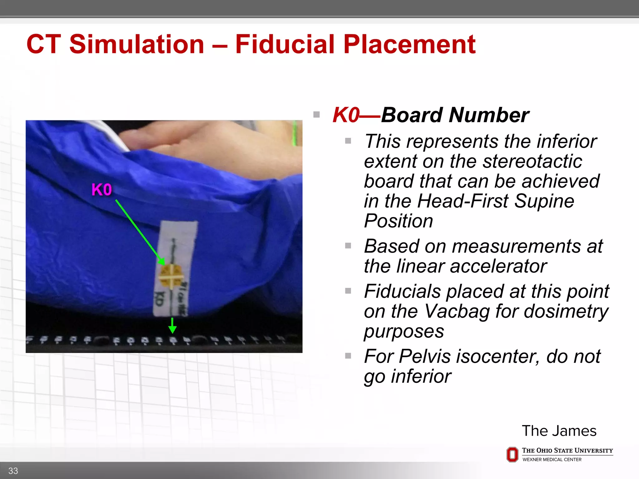 33
CT Simulation – Fiducial Placement
 K0—Board Number
 This represents the inferior
extent on the stereotactic
board that can be achieved
in the Head-First Supine
Position
 Based on measurements at
the linear accelerator
 Fiducials placed at this point
on the Vacbag for dosimetry
purposes
 For Pelvis isocenter, do not
go inferior
 
