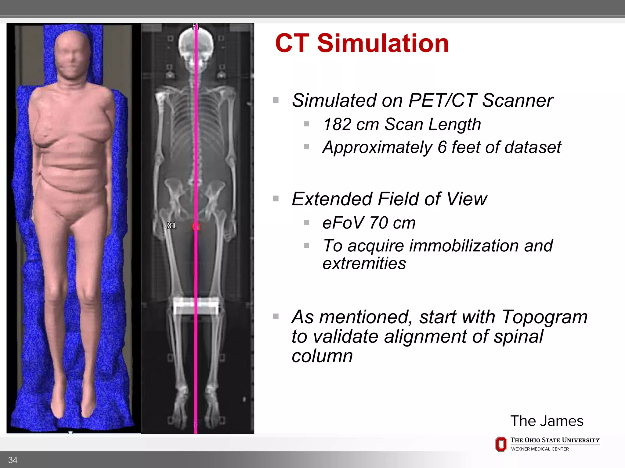  Simulated on PET/CT Scanner
 182 cm Scan Length
 Approximately 6 feet of dataset
 Extended Field of View
 eFoV 70 cm
 To acquire immobilization and
extremities
 As mentioned, start with Topogram
to validate alignment of spinal
column
34
CT Simulation
 