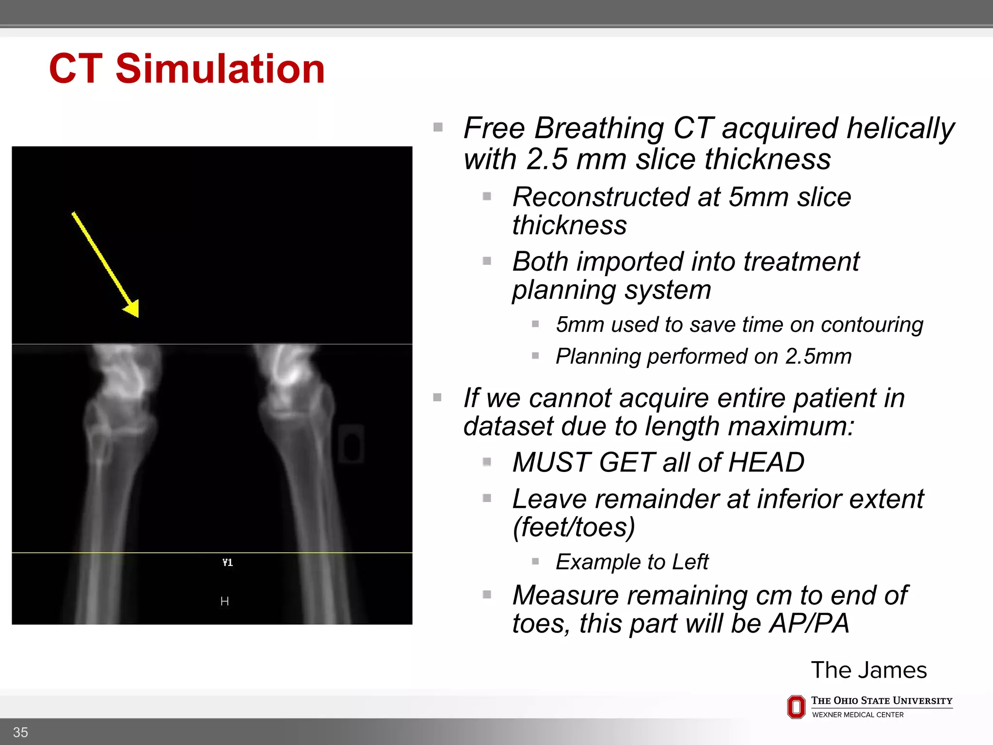  Free Breathing CT acquired helically
with 2.5 mm slice thickness
 Reconstructed at 5mm slice
thickness
 Both imported into treatment
planning system
 5mm used to save time on contouring
 Planning performed on 2.5mm
 If we cannot acquire entire patient in
dataset due to length maximum:
 MUST GET all of HEAD
 Leave remainder at inferior extent
(feet/toes)
 Example to Left
 Measure remaining cm to end of
toes, this part will be AP/PA
35
CT Simulation
 