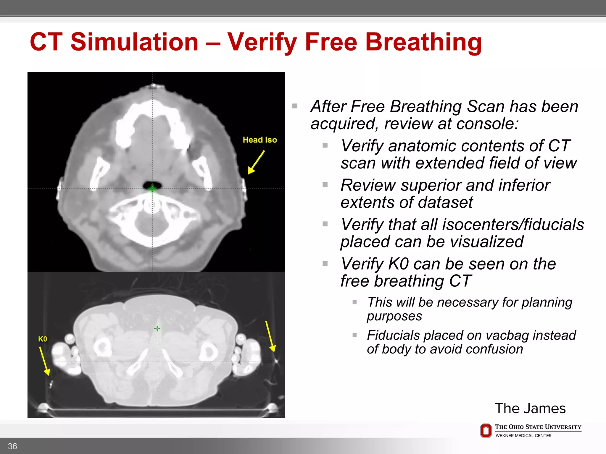 36
CT Simulation – Verify Free Breathing
 After Free Breathing Scan has been
acquired, review at console:
 Verify anatomic contents of CT
scan with extended field of view
 Review superior and inferior
extents of dataset
 Verify that all isocenters/fiducials
placed can be visualized
 Verify K0 can be seen on the
free breathing CT
 This will be necessary for planning
purposes
 Fiducials placed on vacbag instead
of body to avoid confusion
 