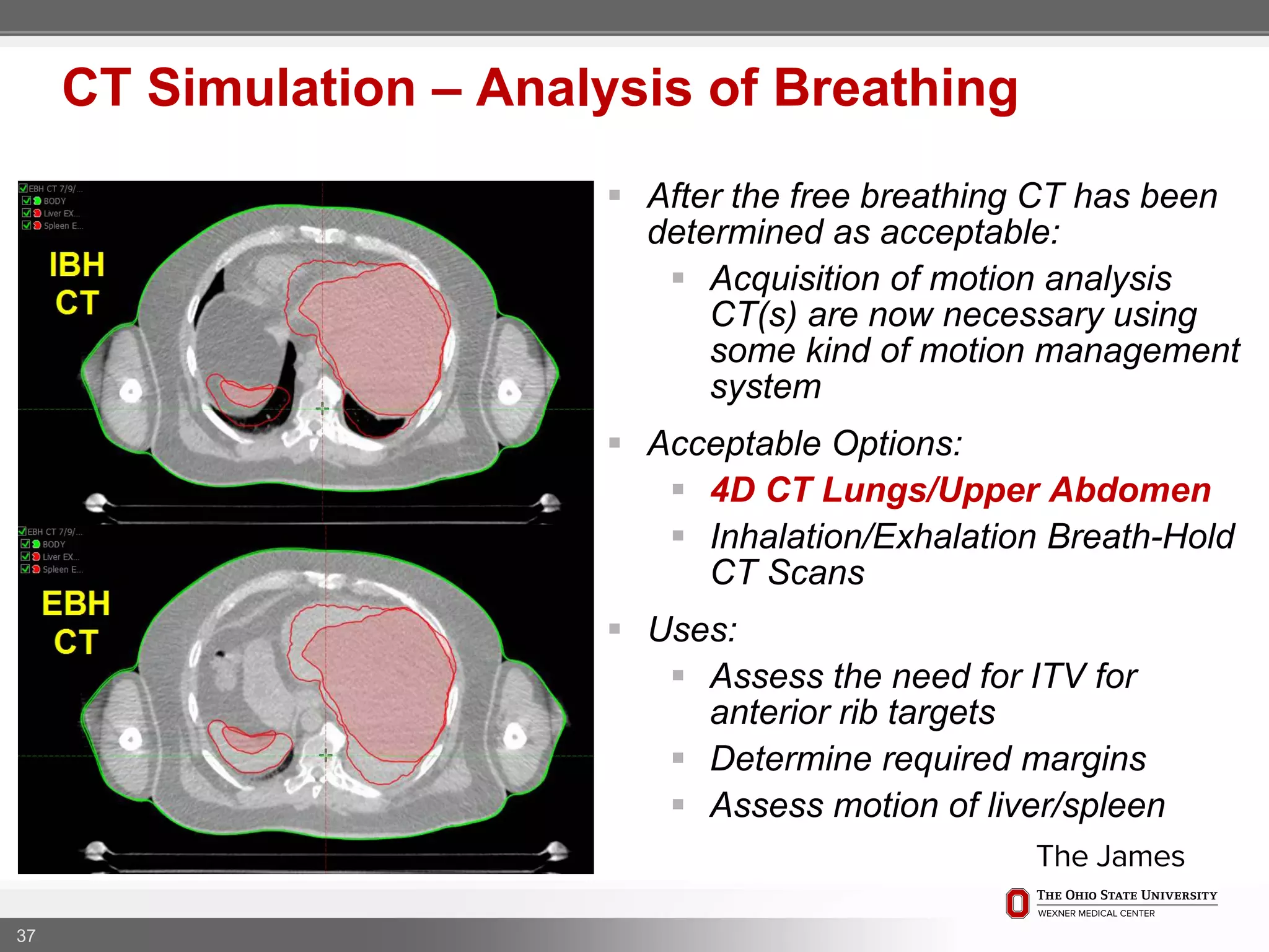 37
CT Simulation – Analysis of Breathing
 After the free breathing CT has been
determined as acceptable:
 Acquisition of motion analysis
CT(s) are now necessary using
some kind of motion management
system
 Acceptable Options:
 4D CT Lungs/Upper Abdomen
 Inhalation/Exhalation Breath-Hold
CT Scans
 Uses:
 Assess the need for ITV for
anterior rib targets
 Determine required margins
 Assess motion of liver/spleen
 
