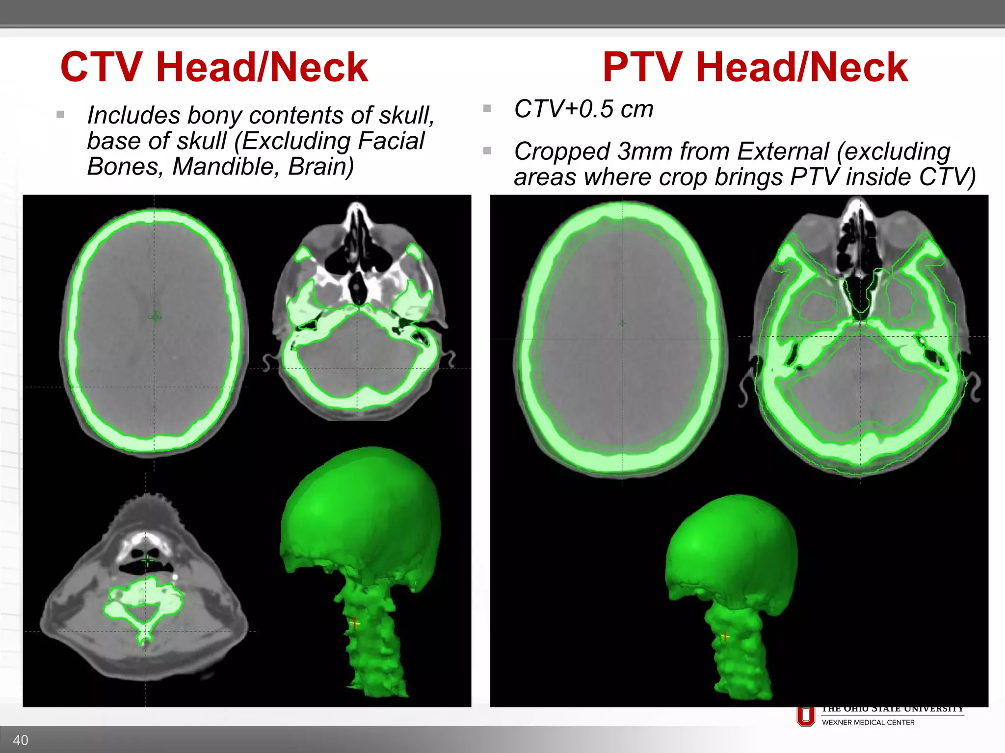 40
CTV Head/Neck PTV Head/Neck
 CTV+0.5 cm
 Cropped 3mm from External (excluding
areas where crop brings PTV inside CTV)
 Includes bony contents of skull,
base of skull (Excluding Facial
Bones, Mandible, Brain)
 