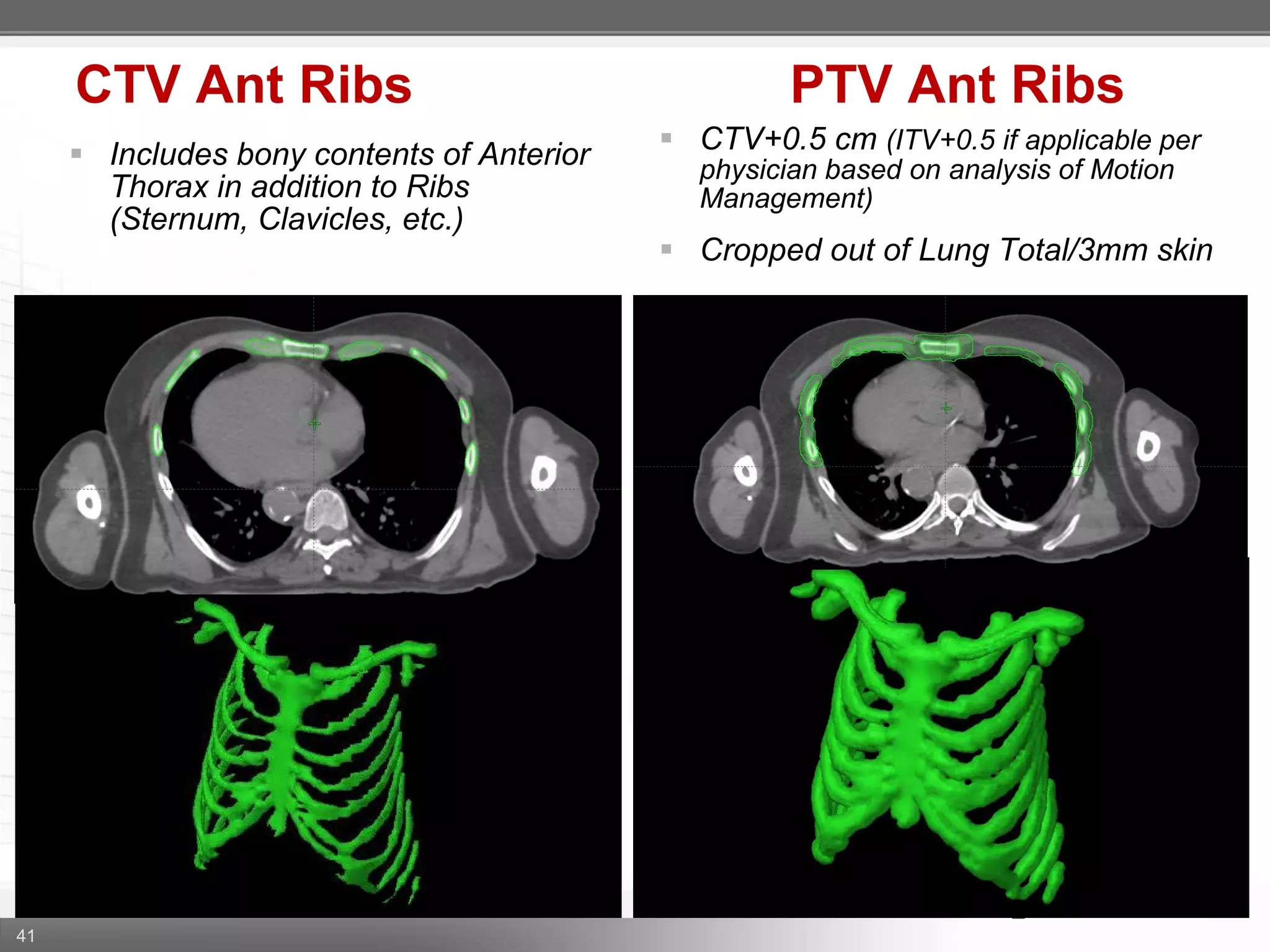 41
CTV Ant Ribs PTV Ant Ribs
 CTV+0.5 cm (ITV+0.5 if applicable per
physician based on analysis of Motion
Management)
 Cropped out of Lung Total/3mm skin
 Includes bony contents of Anterior
Thorax in addition to Ribs
(Sternum, Clavicles, etc.)
 