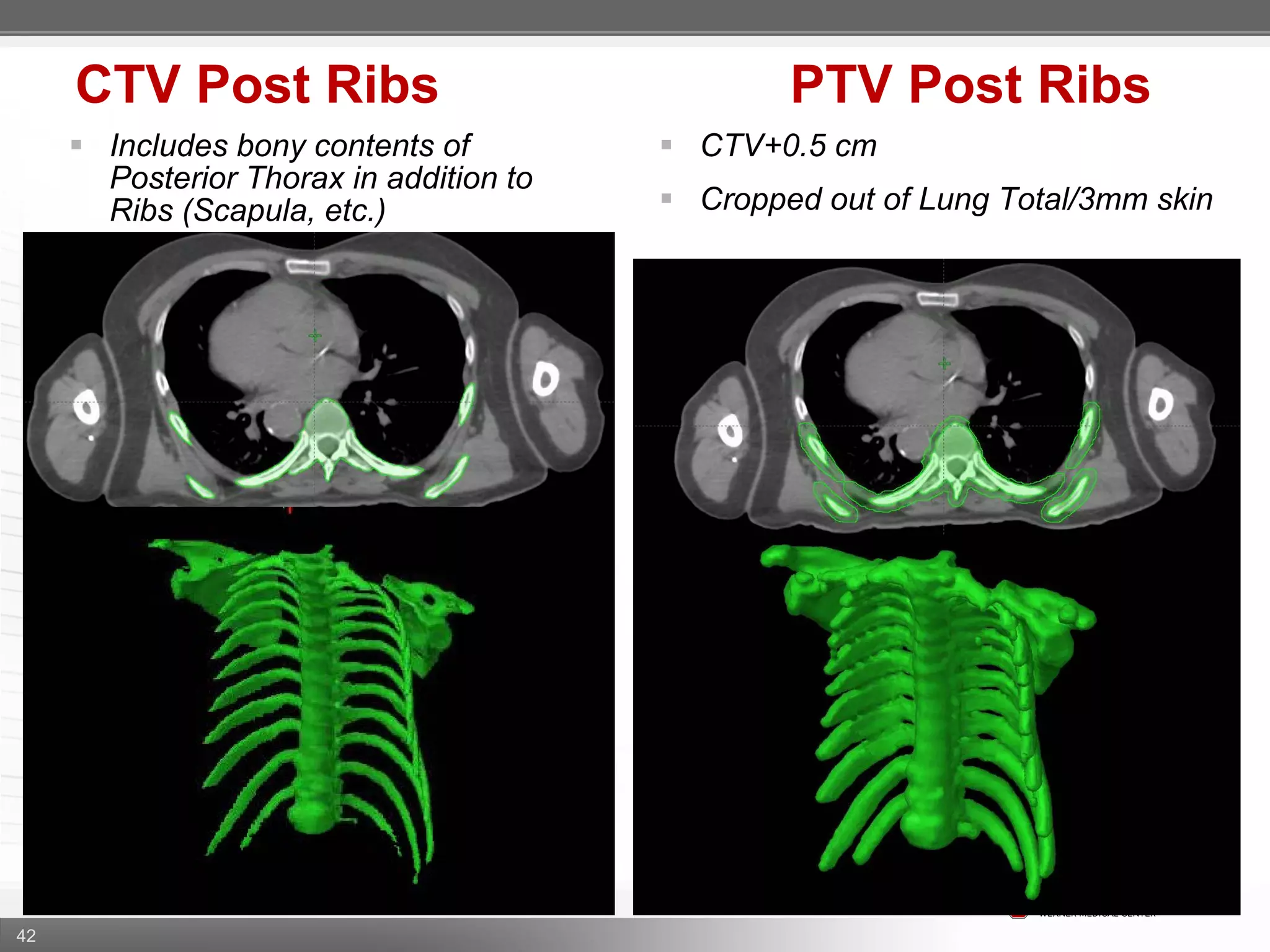 42
CTV Post Ribs PTV Post Ribs
 CTV+0.5 cm
 Cropped out of Lung Total/3mm skin
 Includes bony contents of
Posterior Thorax in addition to
Ribs (Scapula, etc.)
 