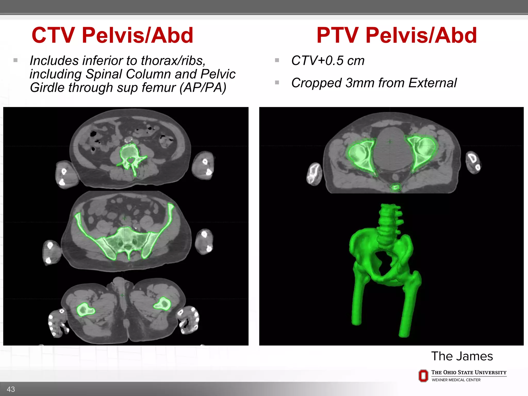 43
CTV Pelvis/Abd PTV Pelvis/Abd
 CTV+0.5 cm
 Cropped 3mm from External
 Includes inferior to thorax/ribs,
including Spinal Column and Pelvic
Girdle through sup femur (AP/PA)
 