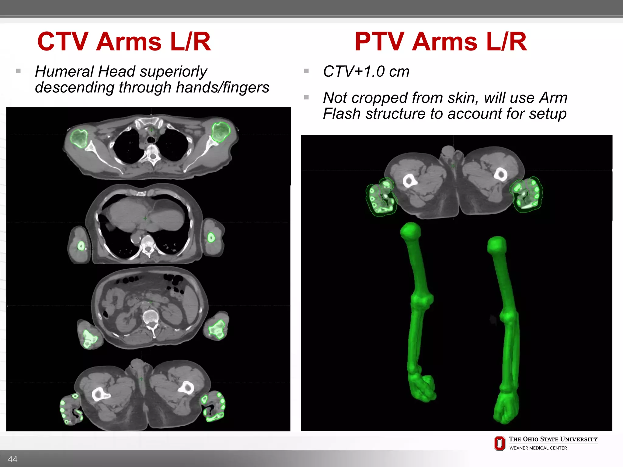 44
CTV Arms L/R PTV Arms L/R
 CTV+1.0 cm
 Not cropped from skin, will use Arm
Flash structure to account for setup
 Humeral Head superiorly
descending through hands/fingers
 