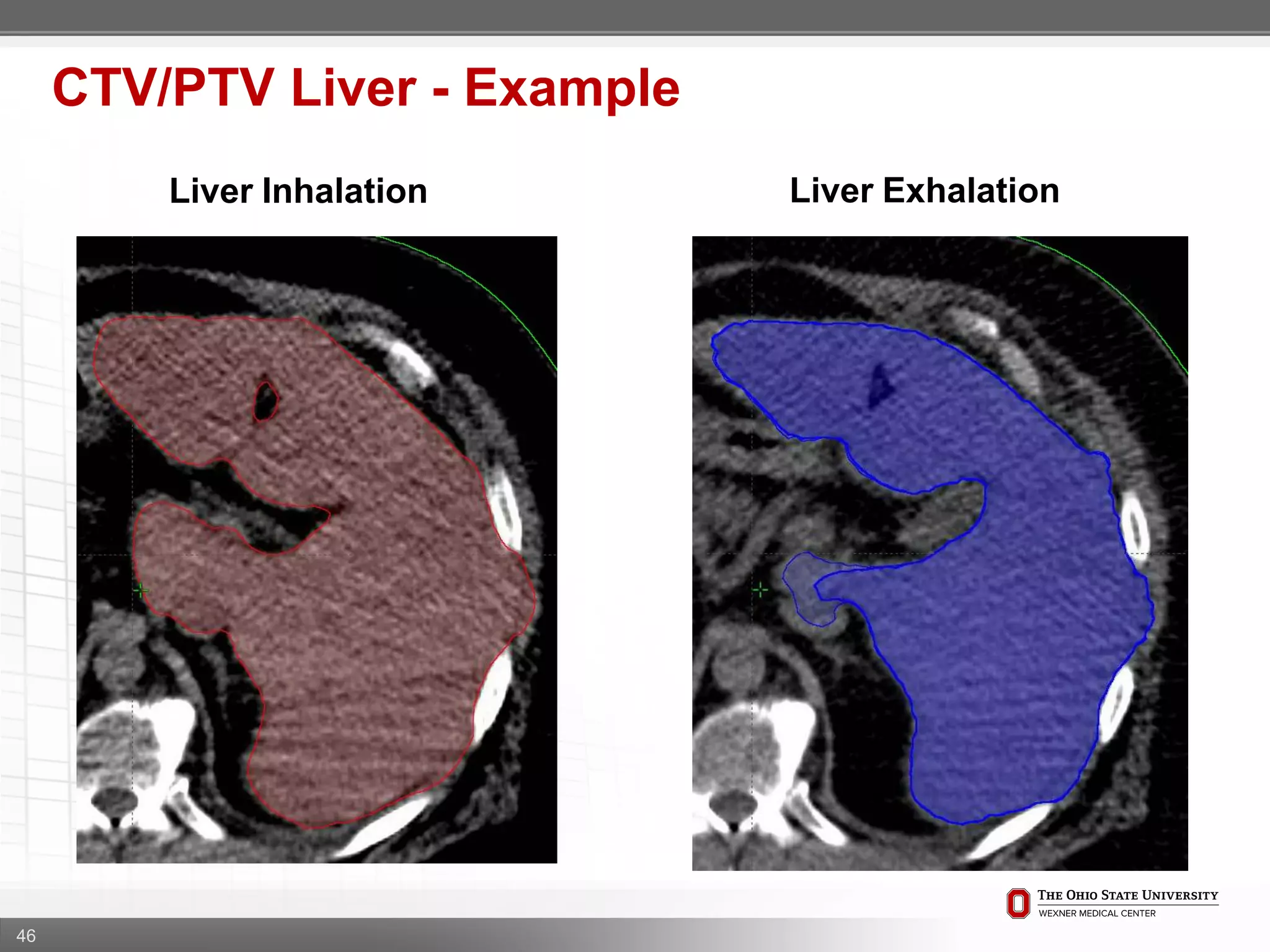 46
CTV/PTV Liver - Example
Liver Inhalation Liver Exhalation
 