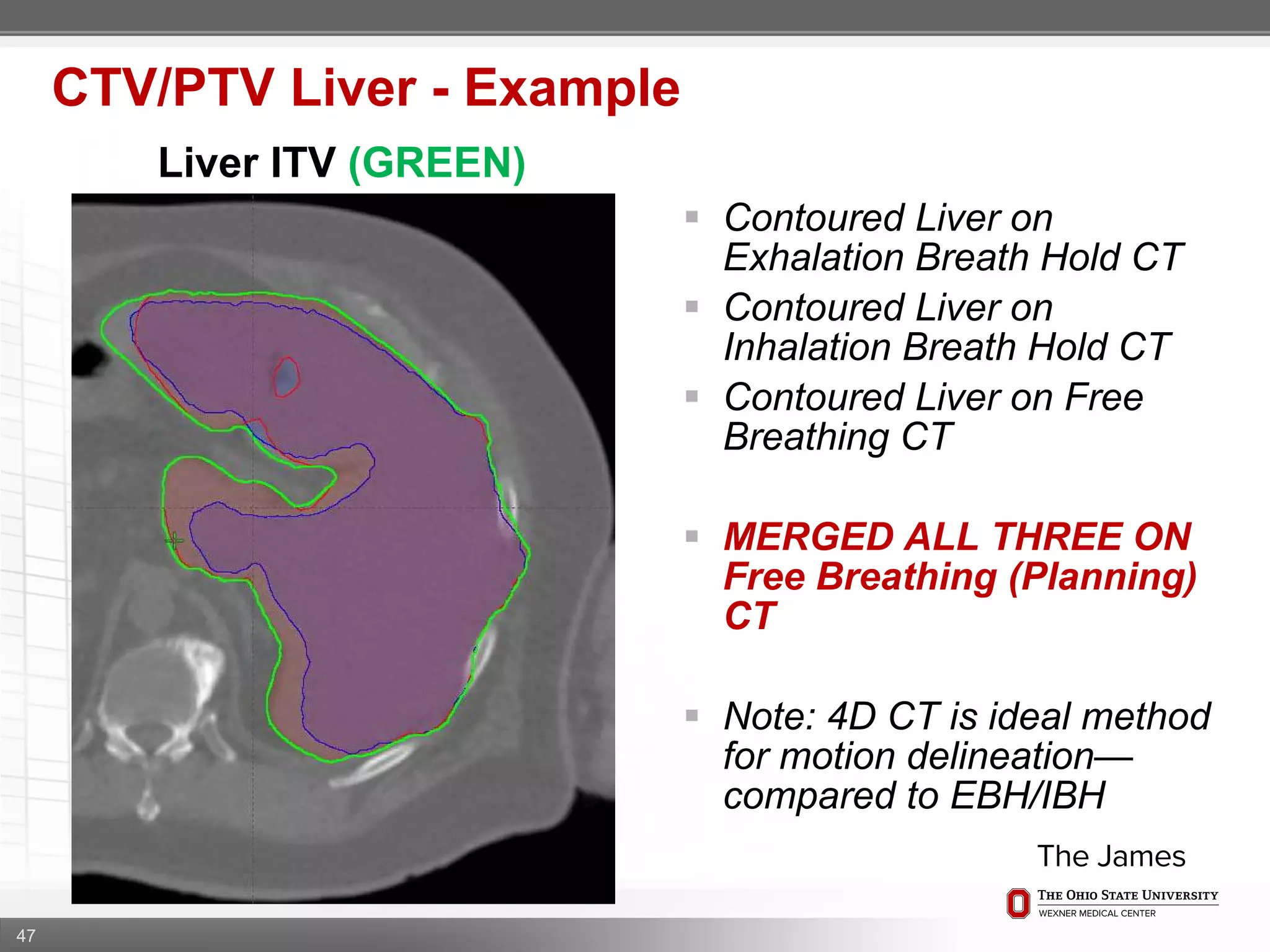 47
CTV/PTV Liver - Example
Liver ITV (GREEN)
 Contoured Liver on
Exhalation Breath Hold CT
 Contoured Liver on
Inhalation Breath Hold CT
 Contoured Liver on Free
Breathing CT
 MERGED ALL THREE ON
Free Breathing (Planning)
CT
 Note: 4D CT is ideal method
for motion delineation—
compared to EBH/IBH
 