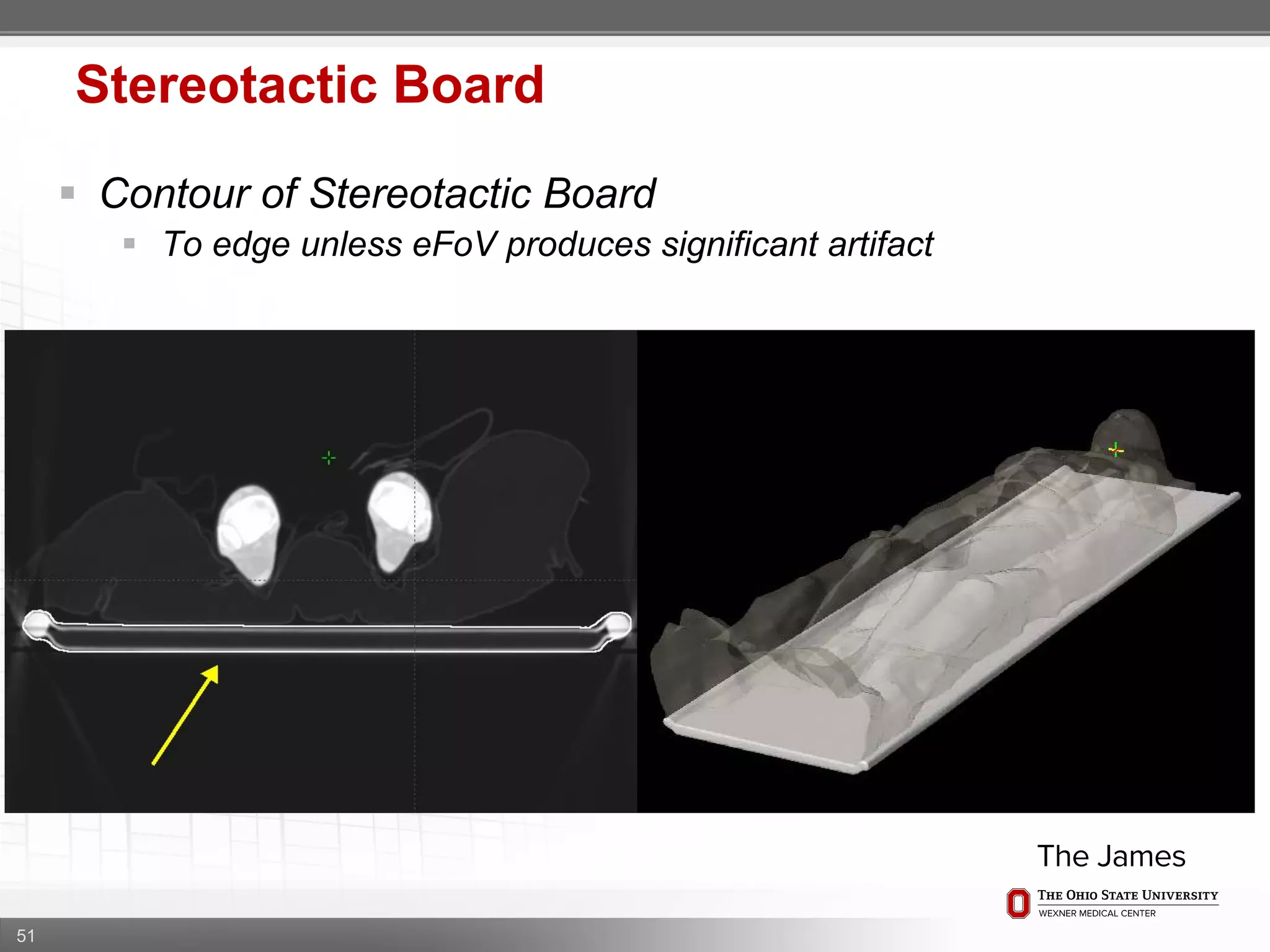 51
Stereotactic Board
 Contour of Stereotactic Board
 To edge unless eFoV produces significant artifact
 