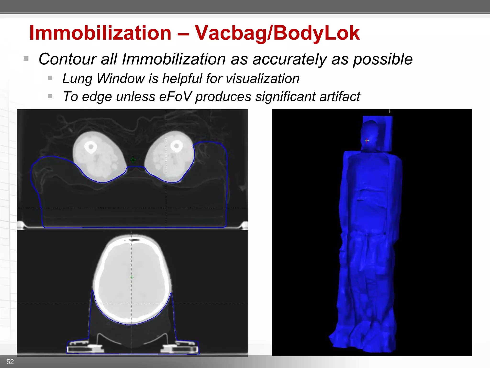 52
Immobilization – Vacbag/BodyLok
 Contour all Immobilization as accurately as possible
 Lung Window is helpful for visualization
 To edge unless eFoV produces significant artifact
 