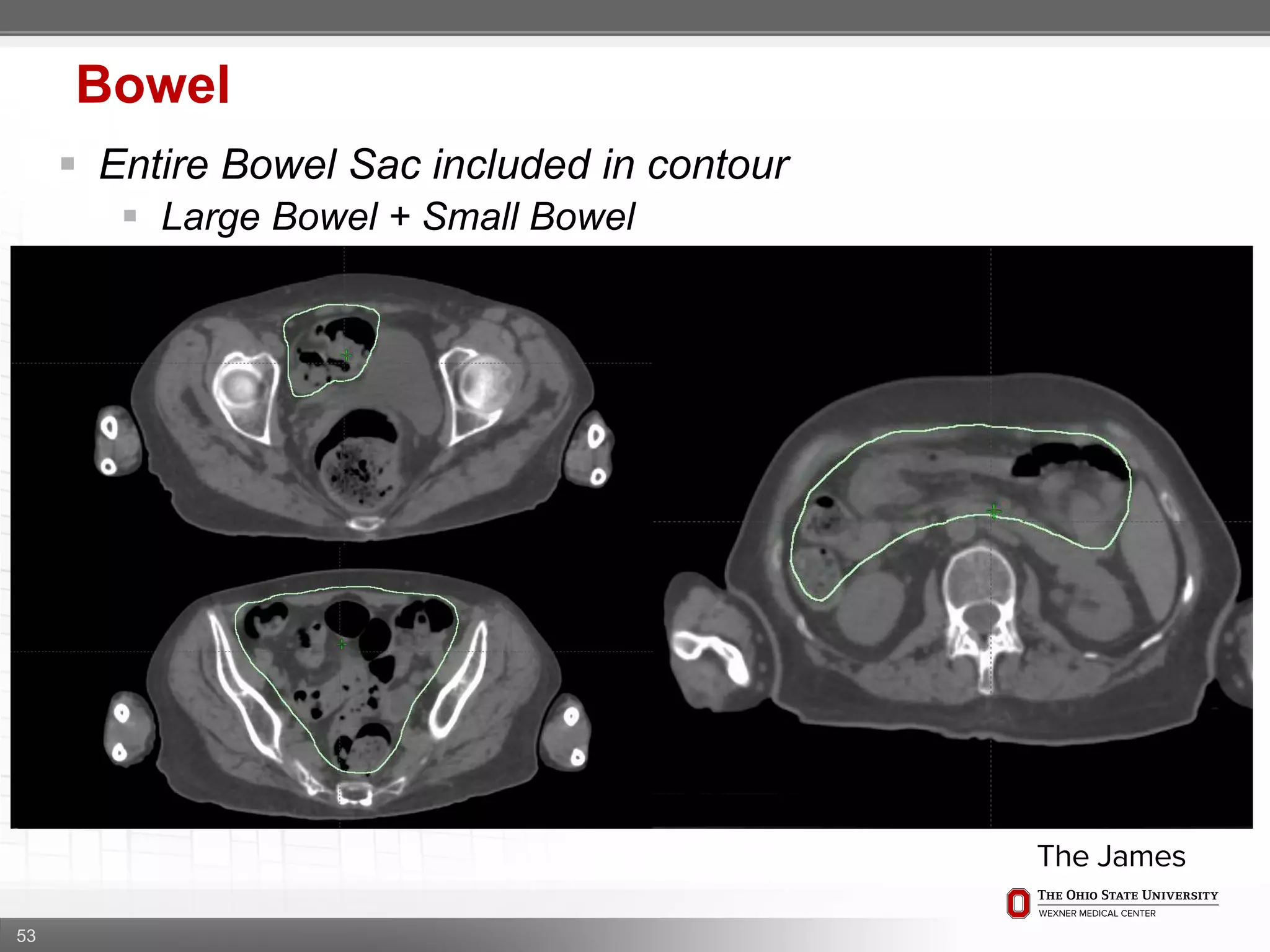 53
Bowel
 Entire Bowel Sac included in contour
 Large Bowel + Small Bowel
 
