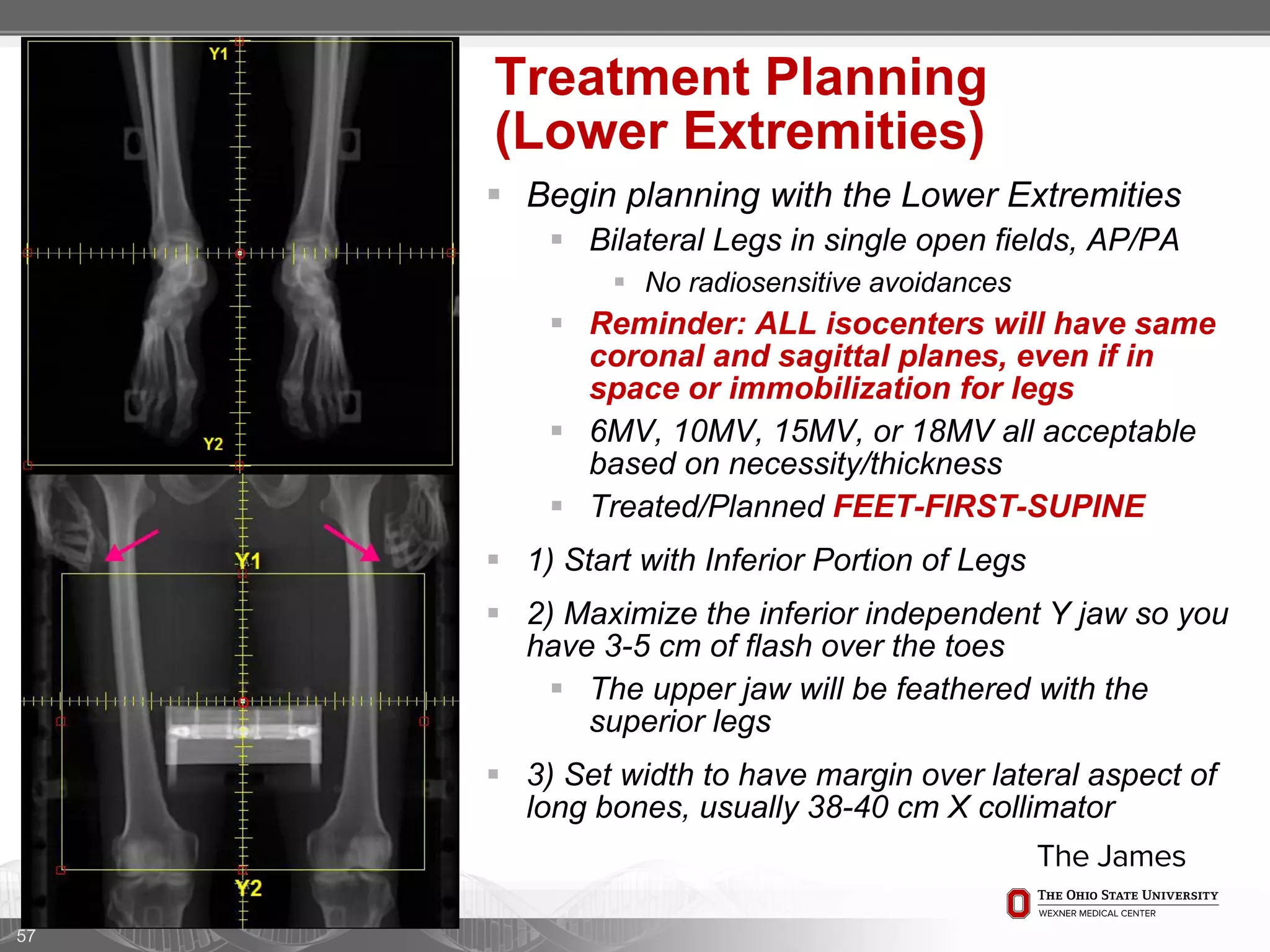57
Treatment Planning
(Lower Extremities)
 Begin planning with the Lower Extremities
 Bilateral Legs in single open fields, AP/PA
 No radiosensitive avoidances
 Reminder: ALL isocenters will have same
coronal and sagittal planes, even if in
space or immobilization for legs
 6MV, 10MV, 15MV, or 18MV all acceptable
based on necessity/thickness
 Treated/Planned FEET-FIRST-SUPINE
 1) Start with Inferior Portion of Legs
 2) Maximize the inferior independent Y jaw so you
have 3-5 cm of flash over the toes
 The upper jaw will be feathered with the
superior legs
 3) Set width to have margin over lateral aspect of
long bones, usually 38-40 cm X collimator
 