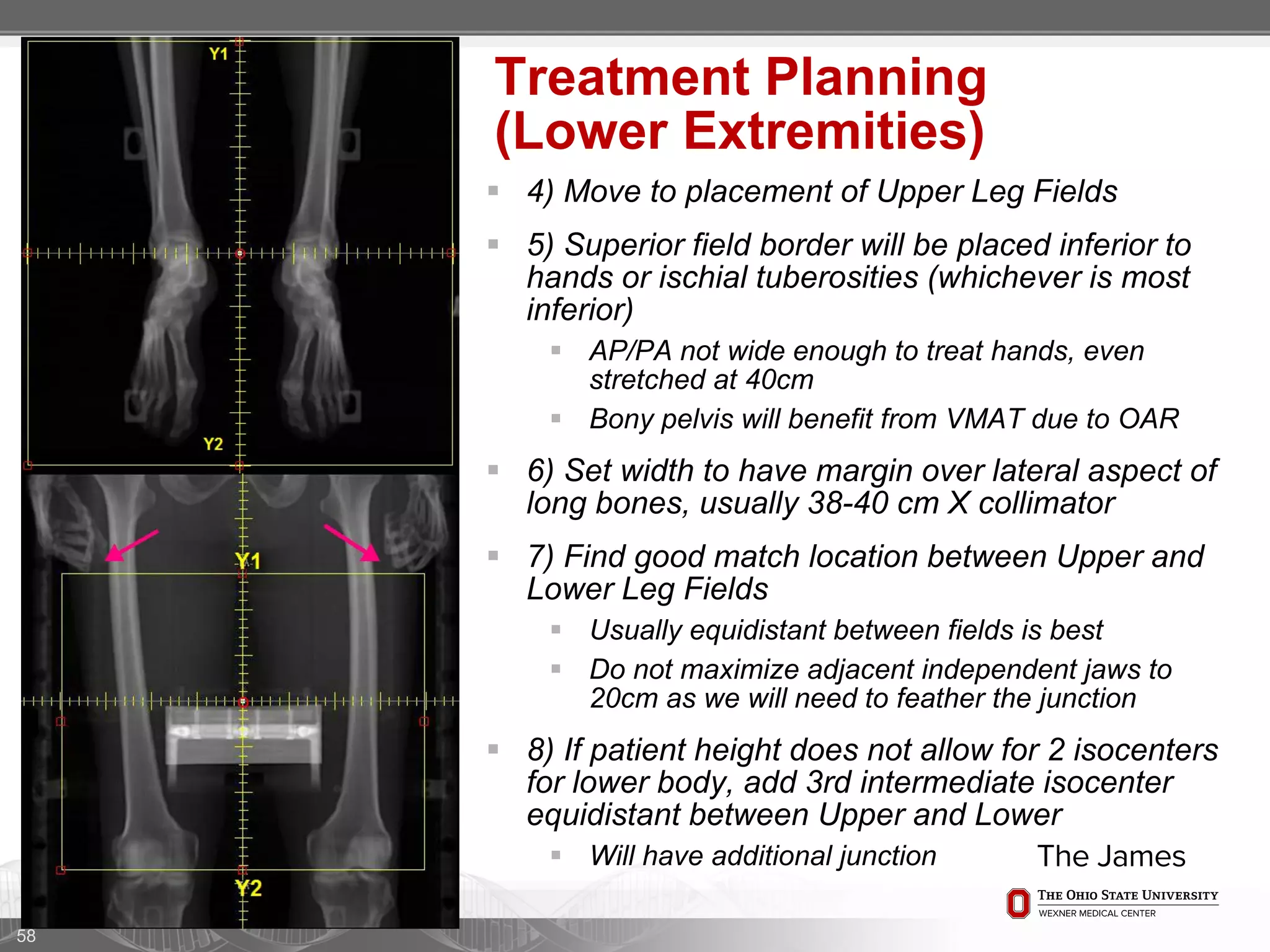 58
Treatment Planning
(Lower Extremities)
 4) Move to placement of Upper Leg Fields
 5) Superior field border will be placed inferior to
hands or ischial tuberosities (whichever is most
inferior)
 AP/PA not wide enough to treat hands, even
stretched at 40cm
 Bony pelvis will benefit from VMAT due to OAR
 6) Set width to have margin over lateral aspect of
long bones, usually 38-40 cm X collimator
 7) Find good match location between Upper and
Lower Leg Fields
 Usually equidistant between fields is best
 Do not maximize adjacent independent jaws to
20cm as we will need to feather the junction
 8) If patient height does not allow for 2 isocenters
for lower body, add 3rd intermediate isocenter
equidistant between Upper and Lower
 Will have additional junction
 