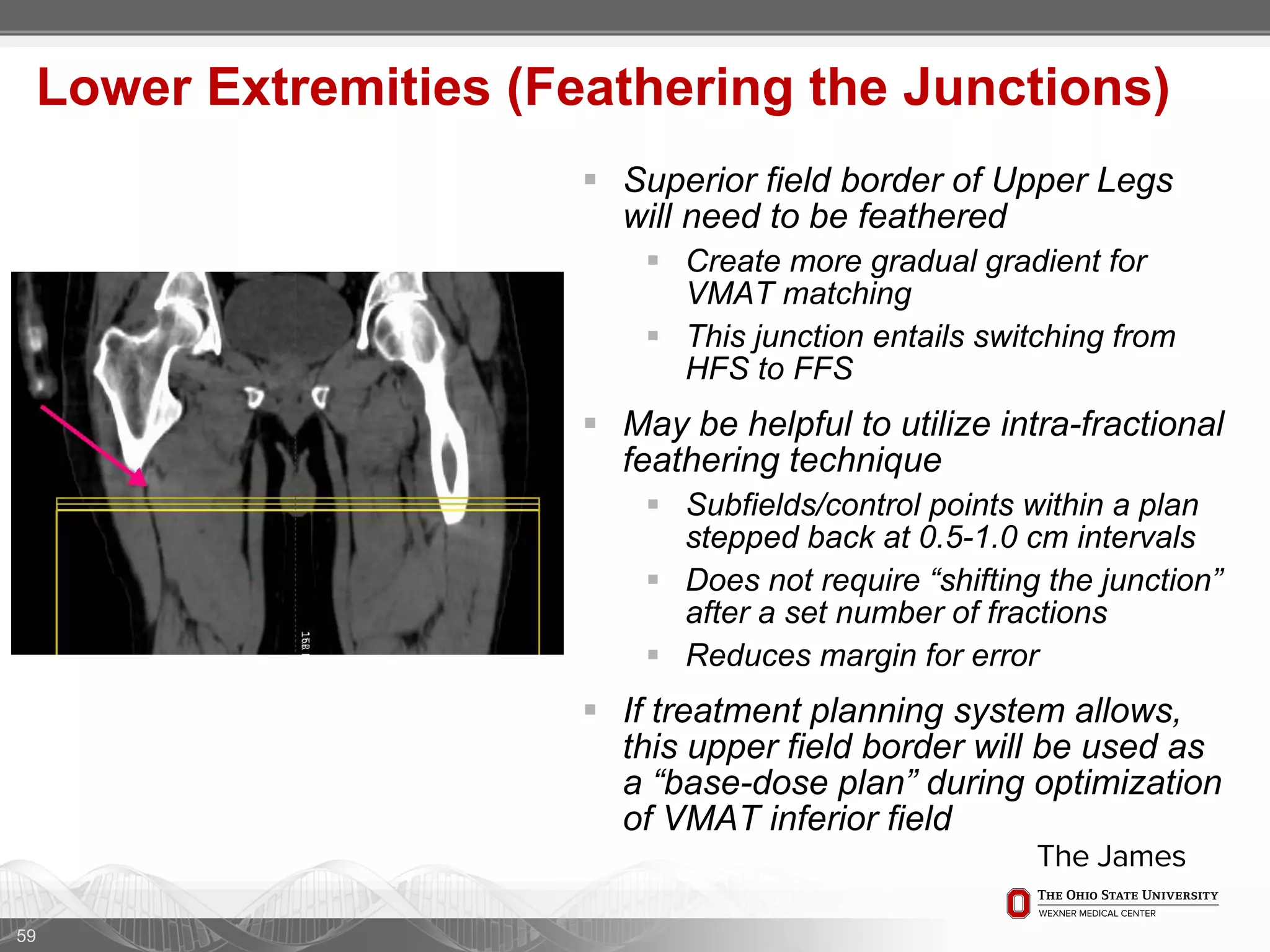 59
Lower Extremities (Feathering the Junctions)
 Superior field border of Upper Legs
will need to be feathered
 Create more gradual gradient for
VMAT matching
 This junction entails switching from
HFS to FFS
 May be helpful to utilize intra-fractional
feathering technique
 Subfields/control points within a plan
stepped back at 0.5-1.0 cm intervals
 Does not require “shifting the junction”
after a set number of fractions
 Reduces margin for error
 If treatment planning system allows,
this upper field border will be used as
a “base-dose plan” during optimization
of VMAT inferior field
 
