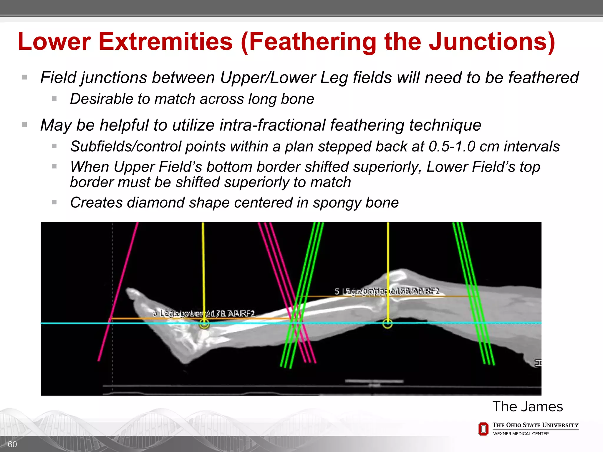 60
Lower Extremities (Feathering the Junctions)
 Field junctions between Upper/Lower Leg fields will need to be feathered
 Desirable to match across long bone
 May be helpful to utilize intra-fractional feathering technique
 Subfields/control points within a plan stepped back at 0.5-1.0 cm intervals
 When Upper Field’s bottom border shifted superiorly, Lower Field’s top
border must be shifted superiorly to match
 Creates diamond shape centered in spongy bone
 