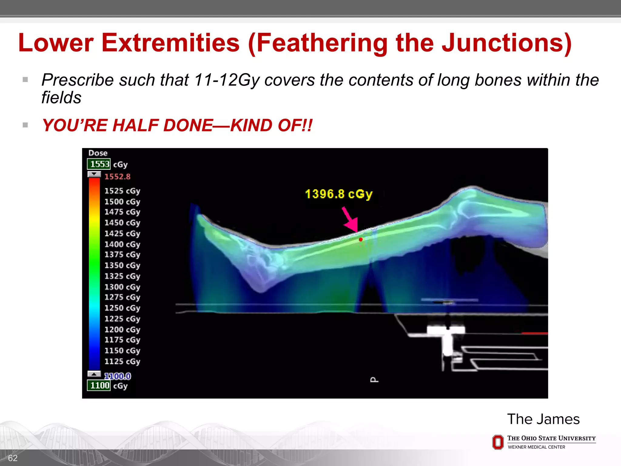 62
Lower Extremities (Feathering the Junctions)
 Prescribe such that 11-12Gy covers the contents of long bones within the
fields
 YOU’RE HALF DONE—KIND OF!!
 