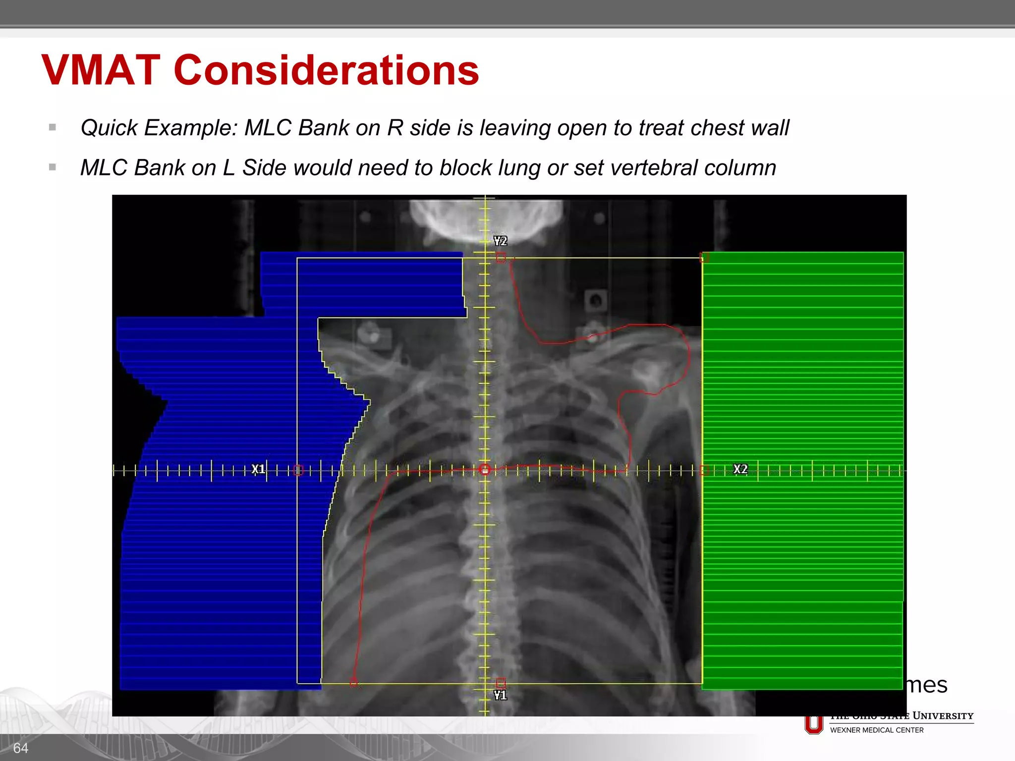 64
VMAT Considerations
 Quick Example: MLC Bank on R side is leaving open to treat chest wall
 MLC Bank on L Side would need to block lung or set vertebral column
 