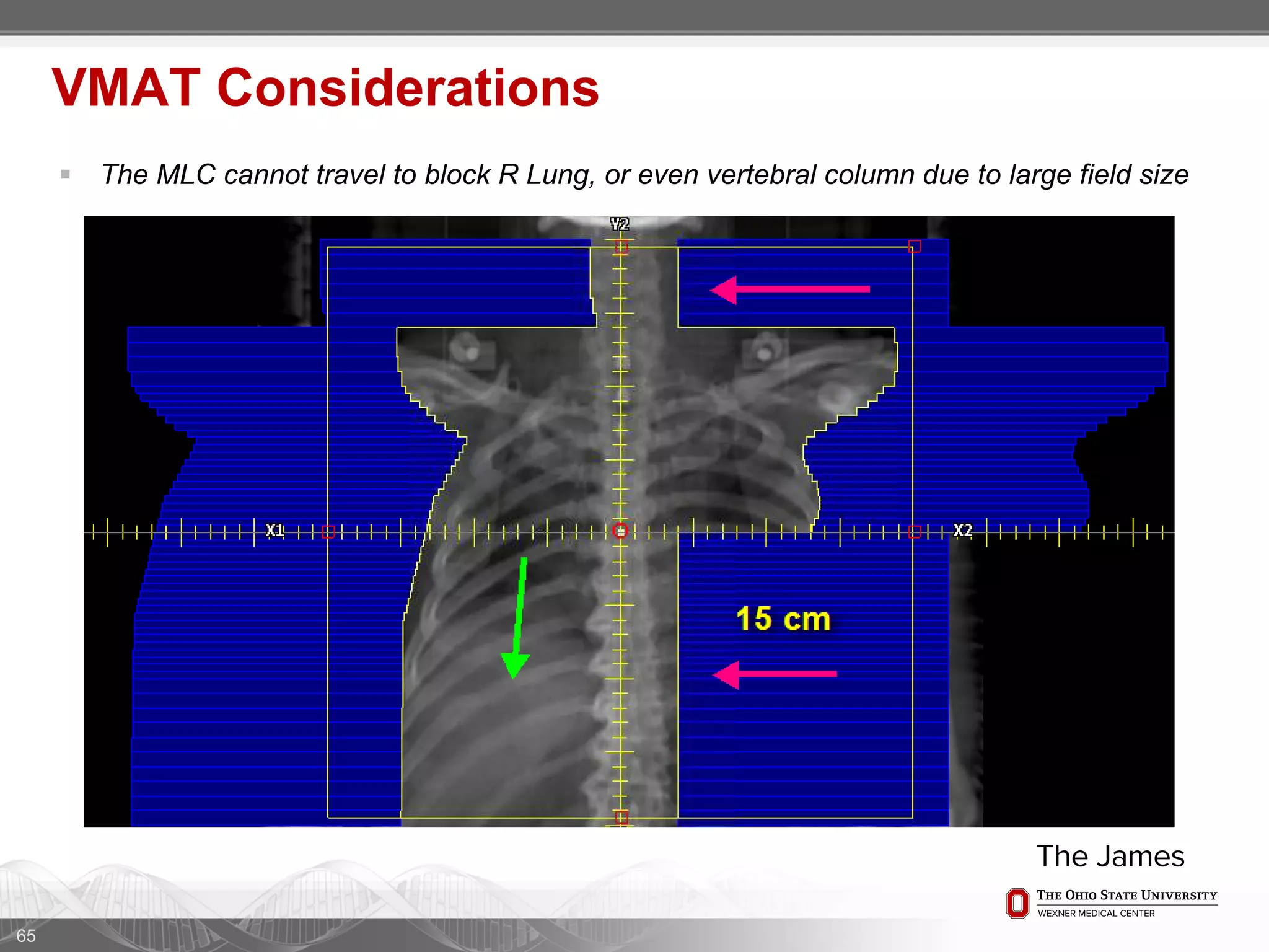 65
VMAT Considerations
 The MLC cannot travel to block R Lung, or even vertebral column due to large field size
 